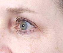botulinum toxin After